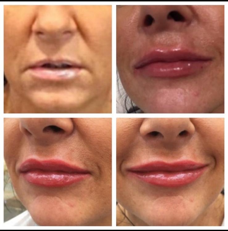 Before and after - Lip enhancement result