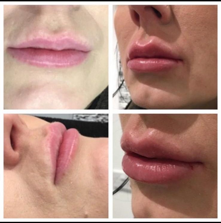 Before and after - Lip enhancement result