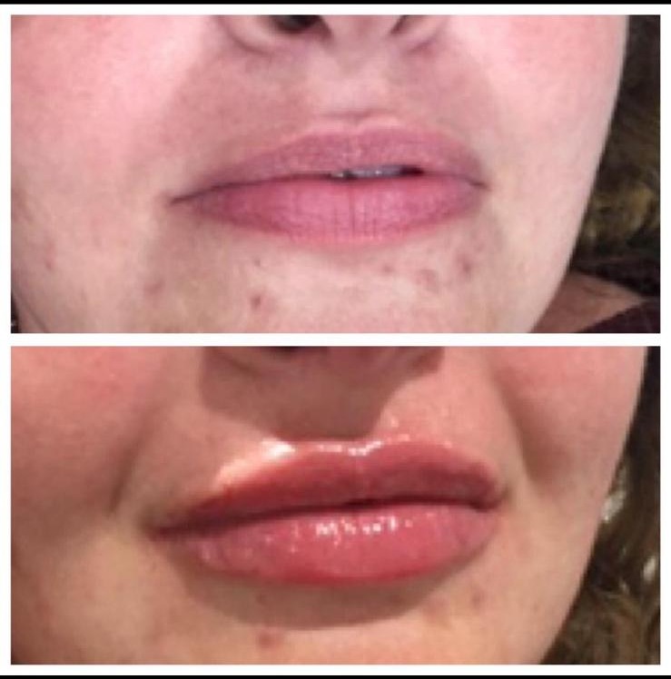 Before and after - Lip enhancement result