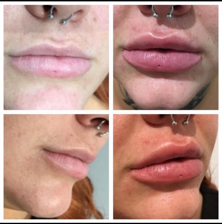 Before and after - Lip enhancement result