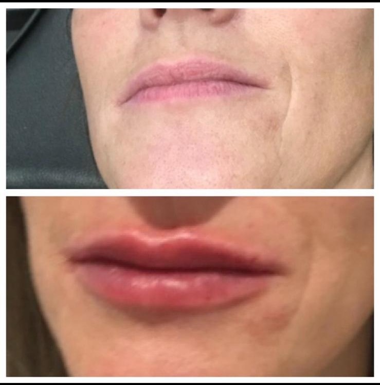 Before and after - Lip enhancement result