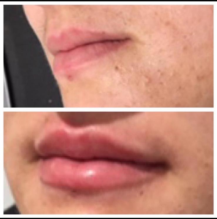Before and after - Lip enhancement result