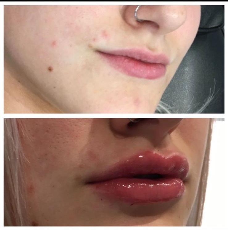 Before and after - Lip enhancement result
