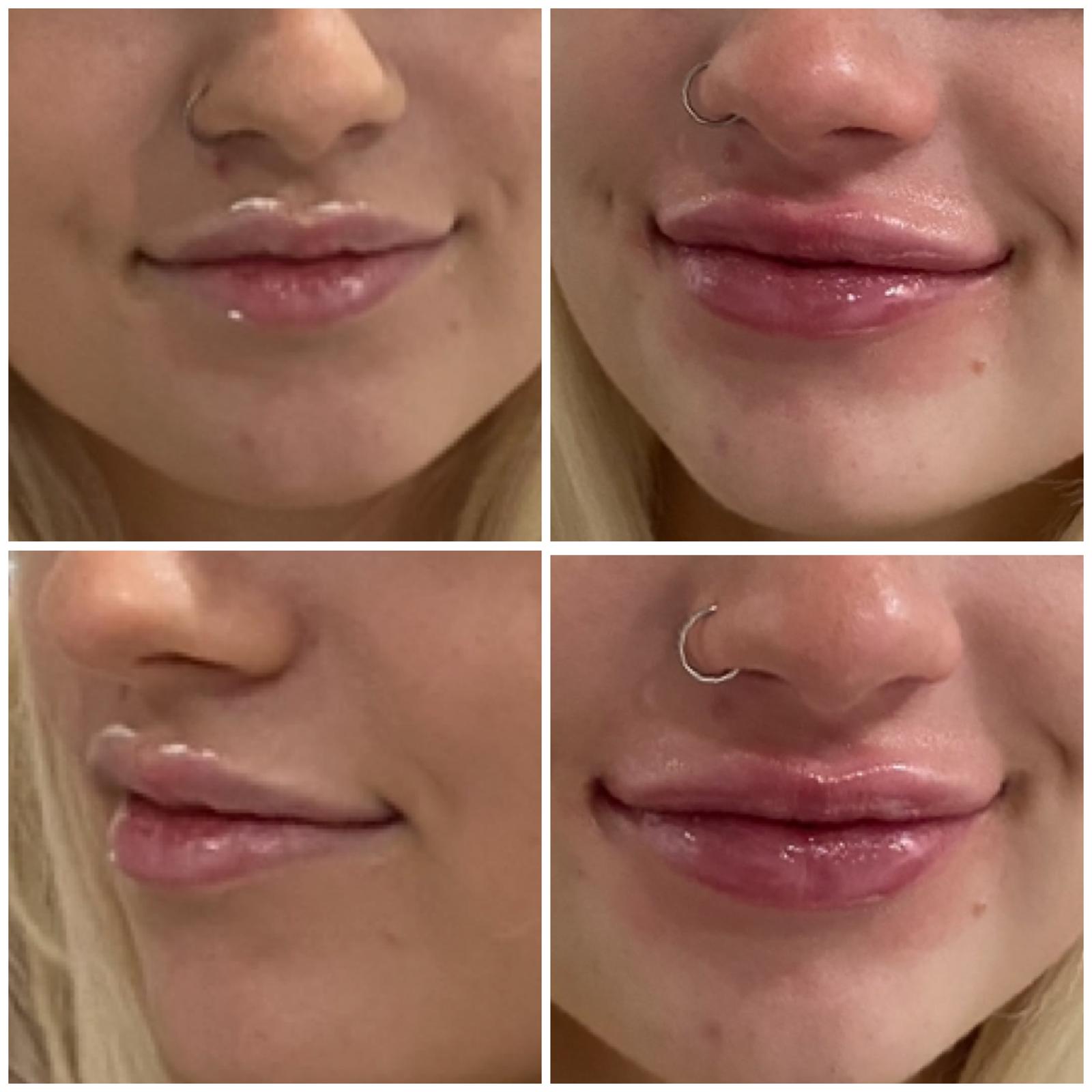 Before and after - Lip enhancement result