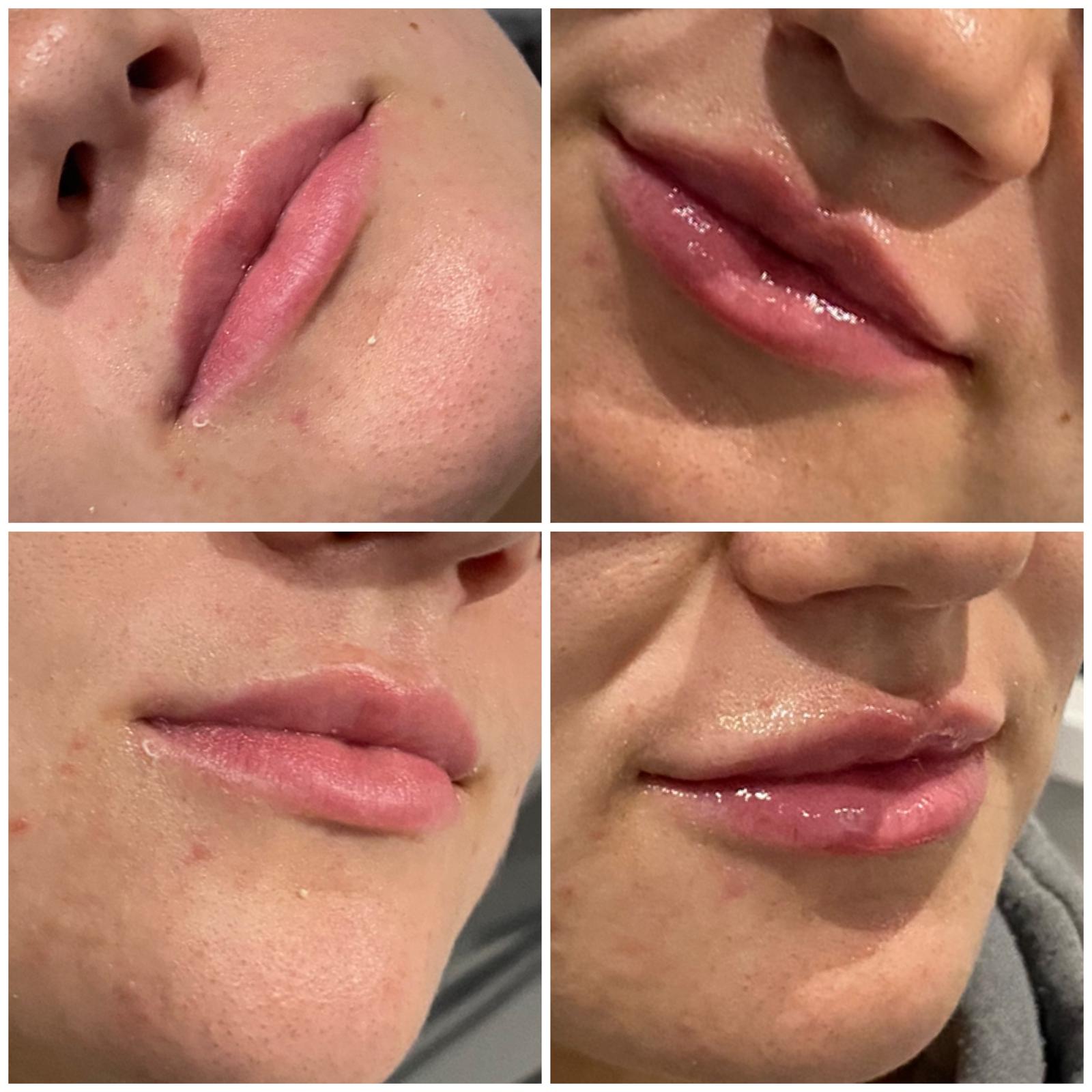 Before and after - Lip enhancement result