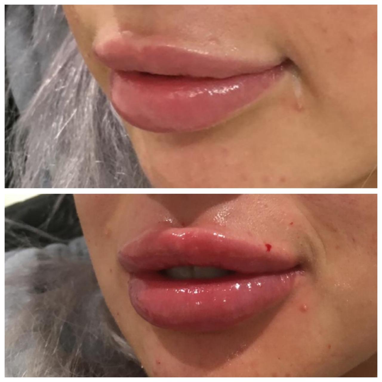 Before and after - Lip enhancement result