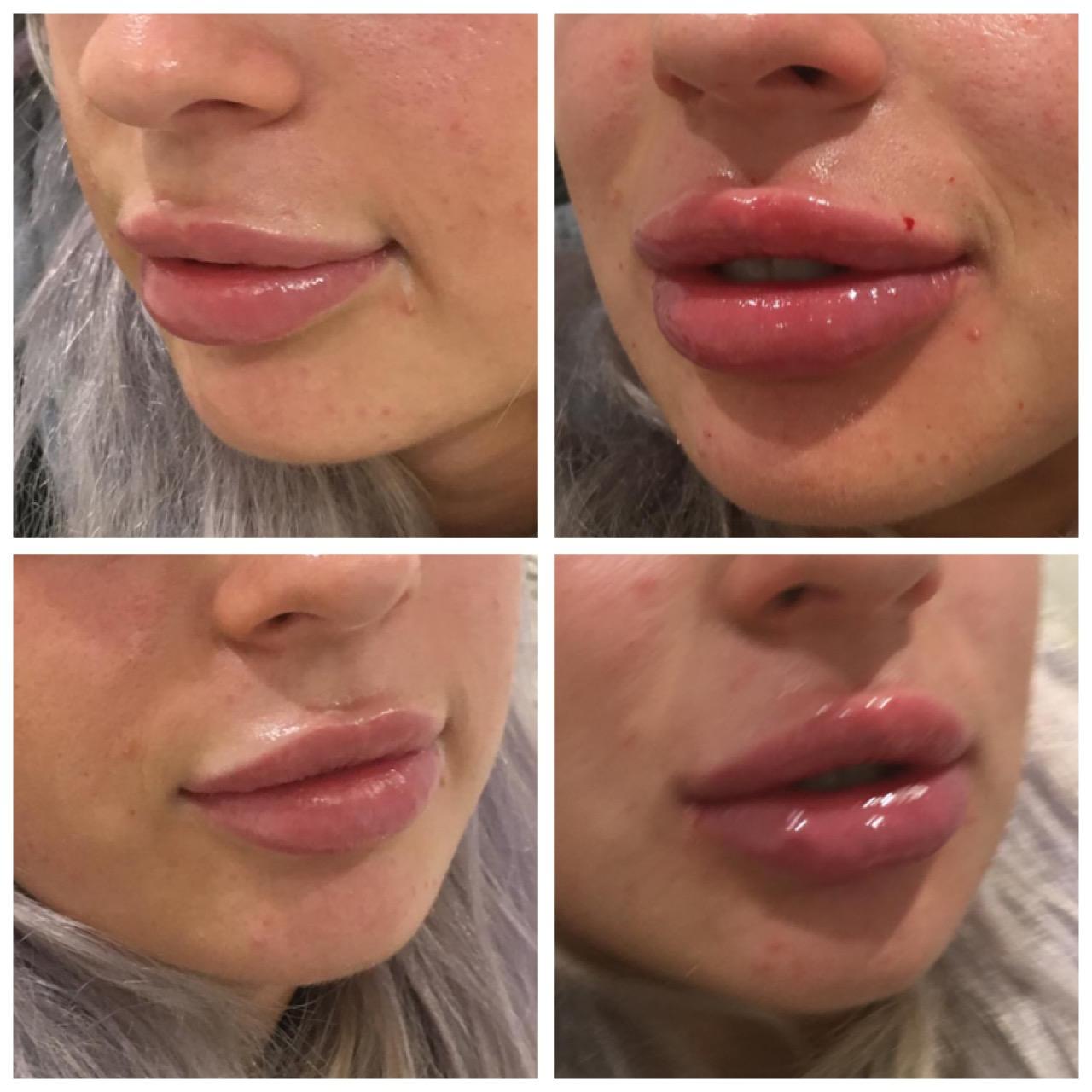 Before and after - Lip enhancement result