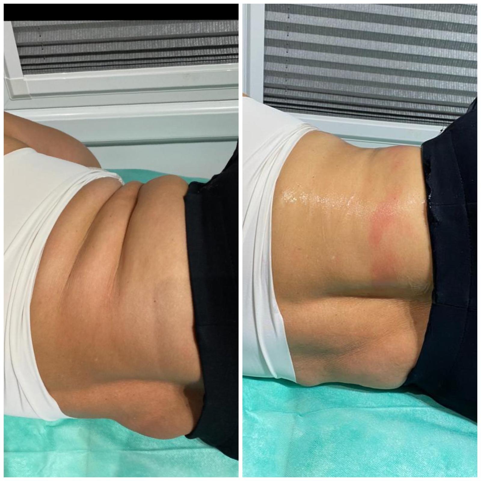 Before and after - Body treatment result