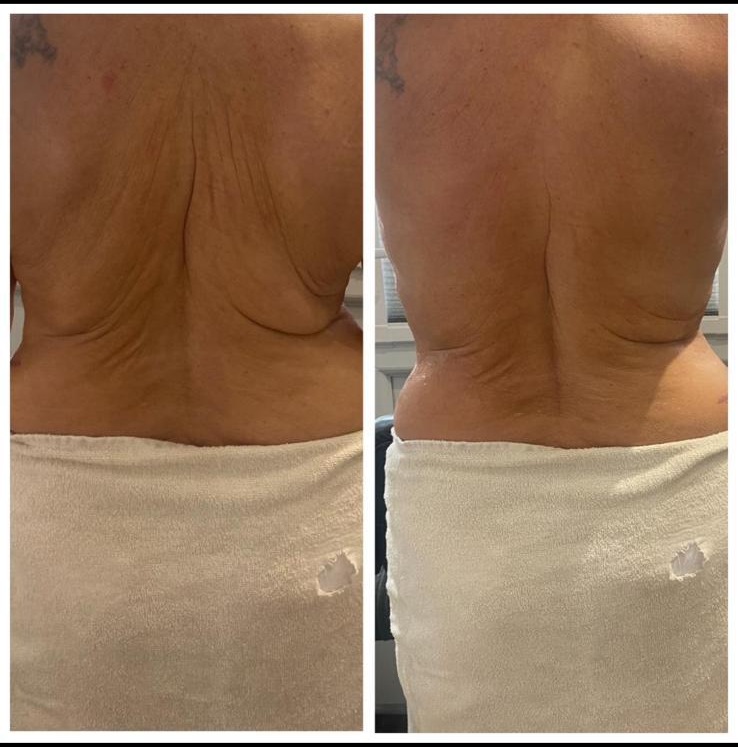 Before and after - Body treatment result