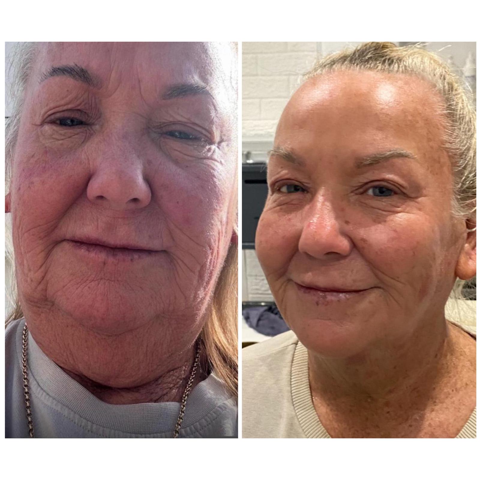 Before and after - Facial rejuvenation result