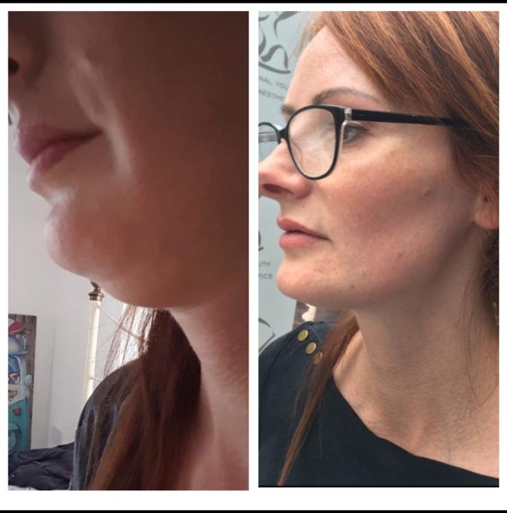 Before and after - Facial treatment result
