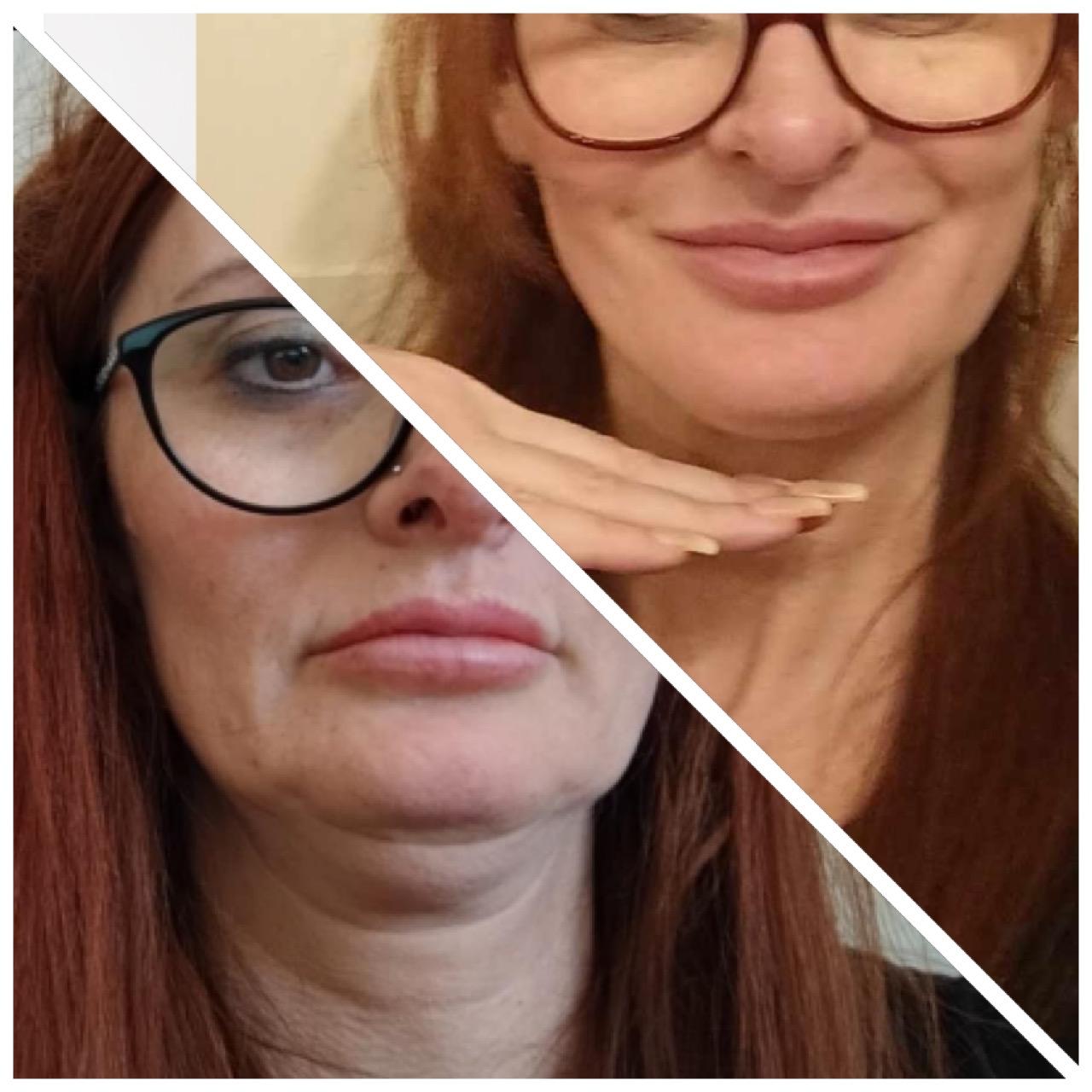 Before and after - Facial treatment result