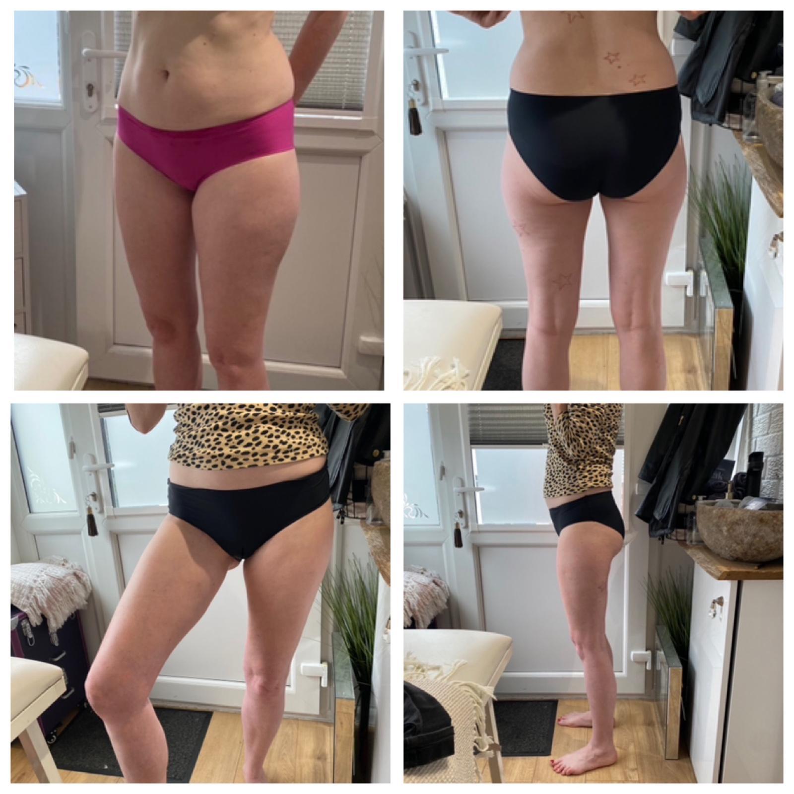 Before and after - Body treatment result