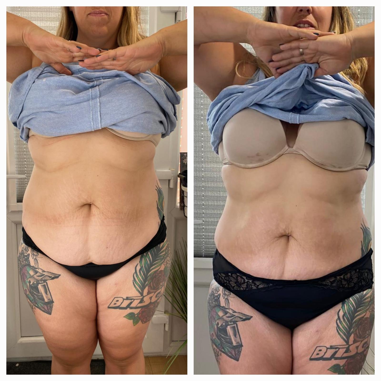 Before and after - Body treatment result