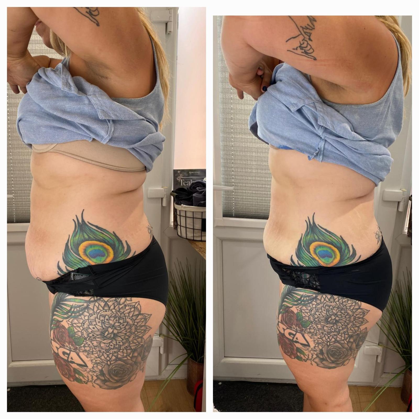 Before and after - Body treatment result